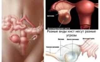 Может ли Ригевидон рассосать фолликулярную кисту?