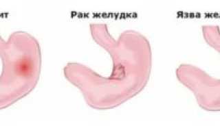 Может ли гастрит перейти в рак желудка?