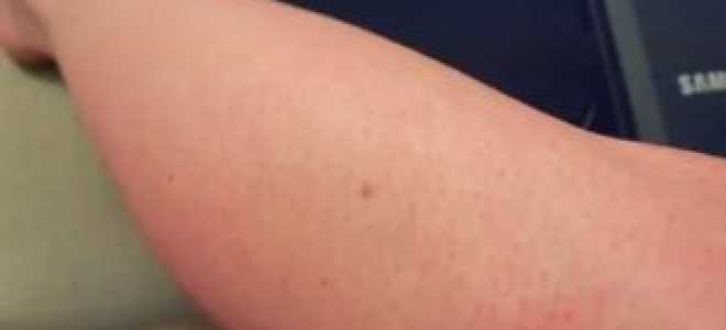 Зуд в ногах и теле от капроновых колготок