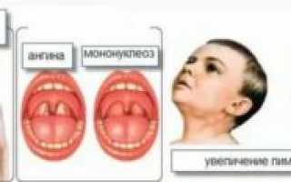 Перенесённый мононуклеоз и планирование беременности