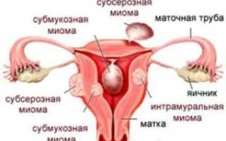 Обертывания при миоме матки