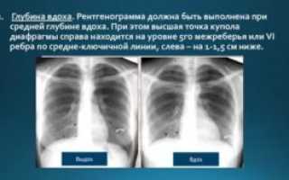 Что значит купол диафрагмы на уровне 5 ребра?